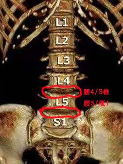 腰4/5椎 腰5/骶1 这两个部位大概在什么位置？