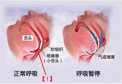 打呼噜主要是什么原因造成？