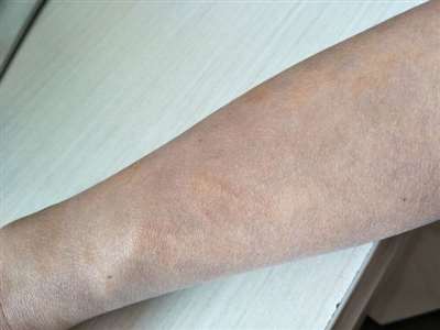 手臂下半部痒后皮肤变成一块块的灰色，是什么病？