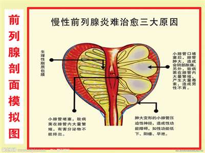 得了前列腺应该怎么治疗呢？