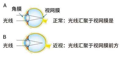 眼镜度数不高但裸眼视力低