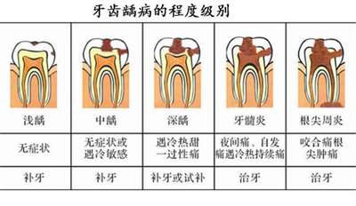 什么牙膏可以防蛀啊？