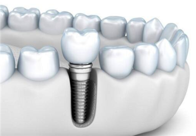 大连做种植牙哪家价格比较优惠？